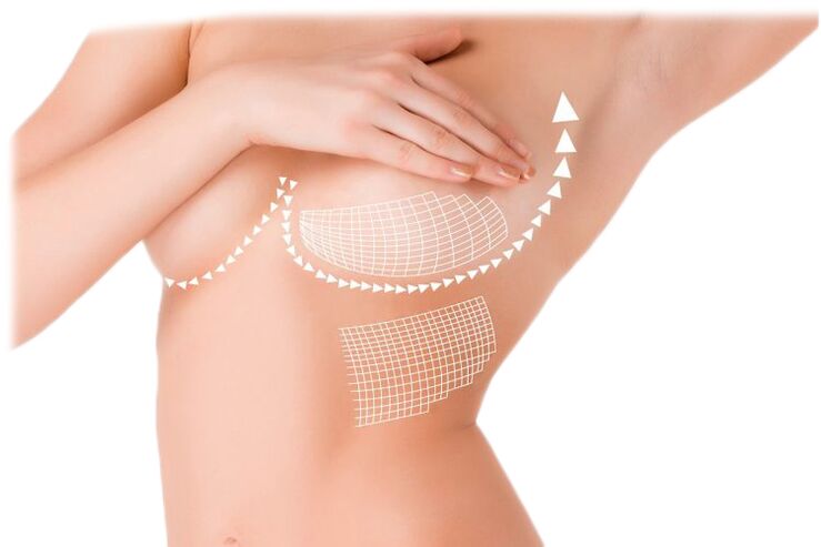 Efecto das cápsulas Mammax para o aumento da mama
