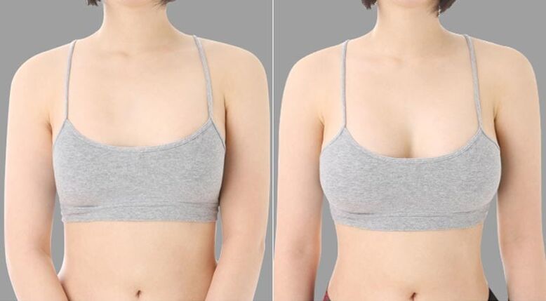 antes e despois do aumento mamario