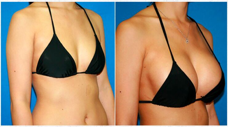 Antes e despois da ampliación dos peitos con cirurxía plástica