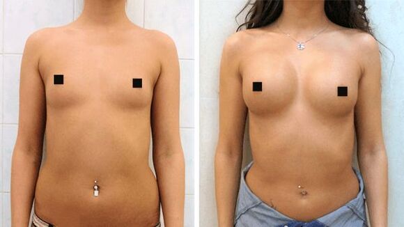 Fotos antes e despois da cirurxía de aumento de mama