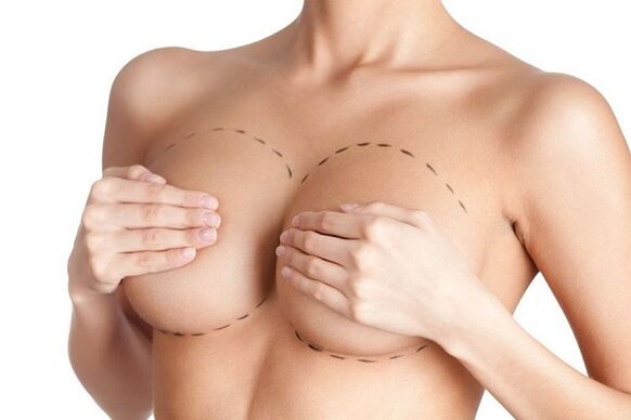 Marcado para cirurxía de aumento de mama