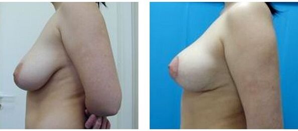antes e despois da cirurxía de aumento de mama