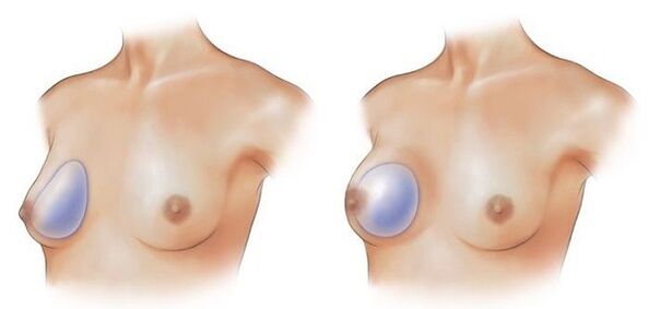 implantes en forma de bágoa e redondos para o aumento do peito