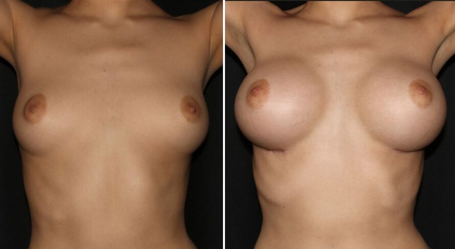 Antes e despois do aumento mamario